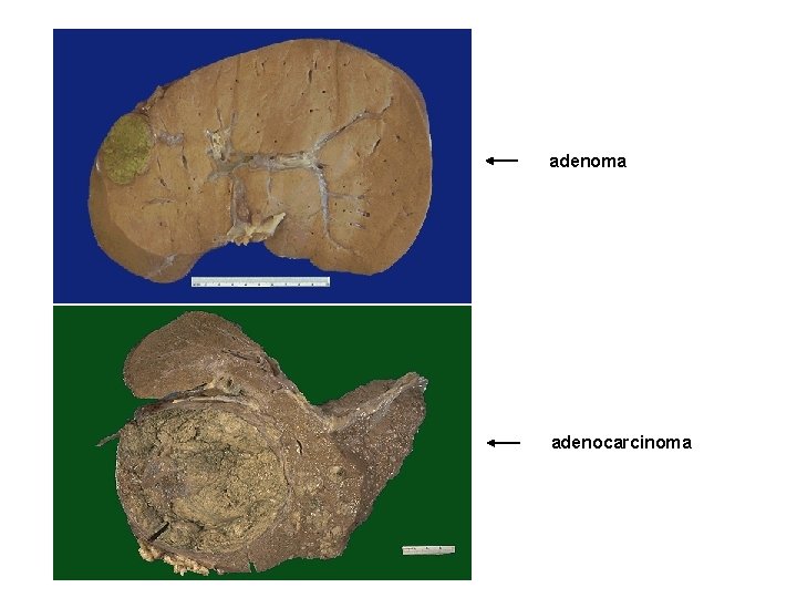 adenoma adenocarcinoma 