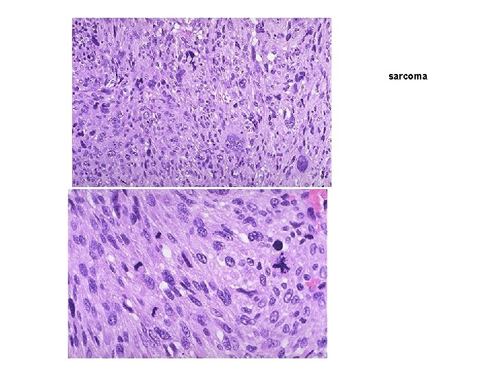 sarcoma 