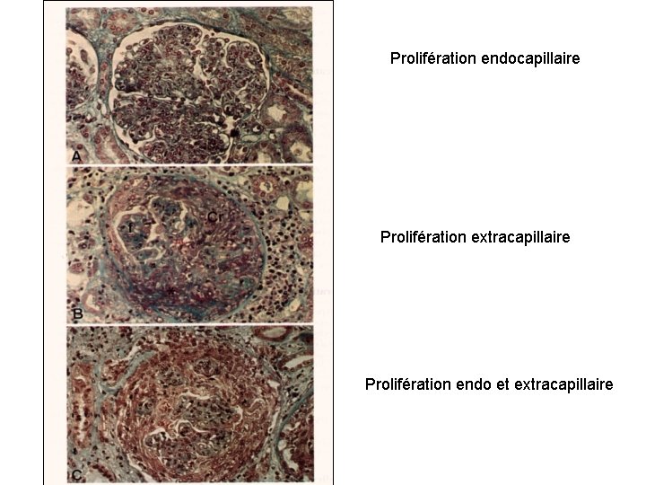 Prolifération endocapillaire Prolifération extracapillaire Prolifération endo et extracapillaire 