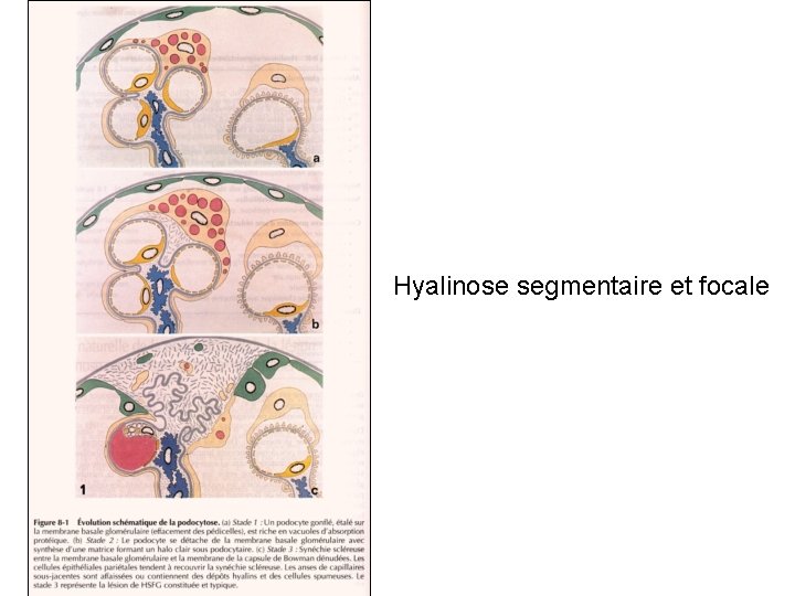 Hyalinose segmentaire et focale 