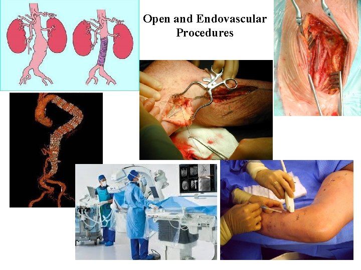 Open and Endovascular Procedures 