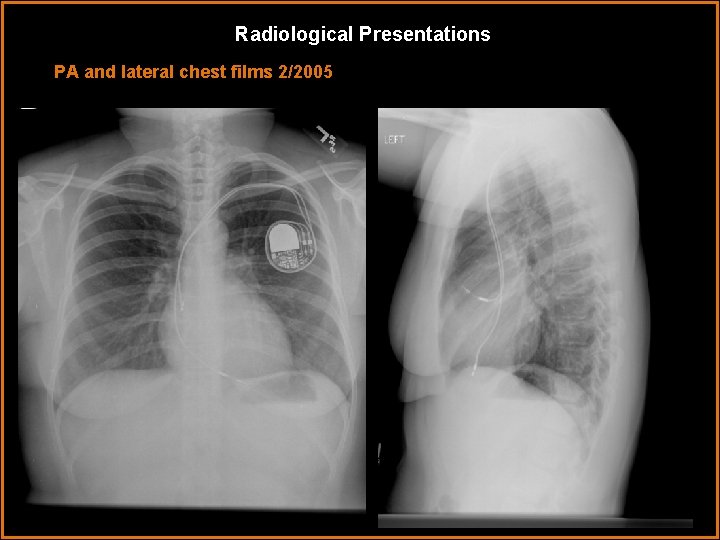 Radiological Presentations PA and lateral chest films 2/2005 