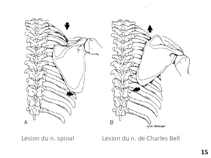 Lésion du n. spinal Lésion du n. de Charles Bell 15 