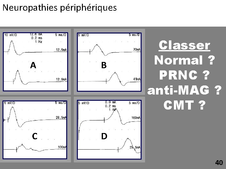 Neuropathies périphériques A B C D Classer Normal ? PRNC ? anti-MAG ? CMT