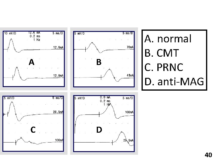 A B C D A. normal B. CMT C. PRNC D. anti-MAG 40 