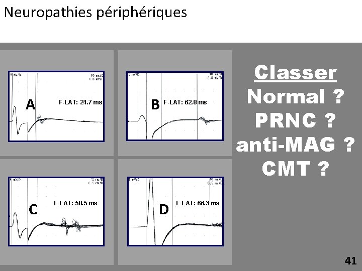 Neuropathies périphériques A C F-LAT: 24. 7 ms F-LAT: 50. 5 ms B F-LAT: