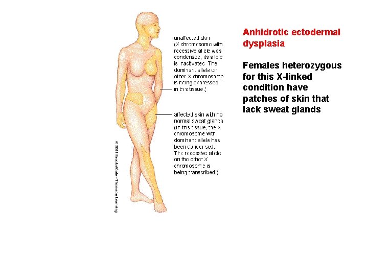 Anhidrotic ectodermal dysplasia Females heterozygous for this X-linked condition have patches of skin that