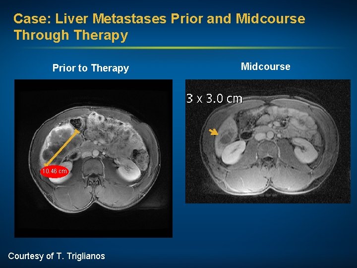 Case: Liver Metastases Prior and Midcourse Through Therapy Prior to Therapy 10. 46 cm