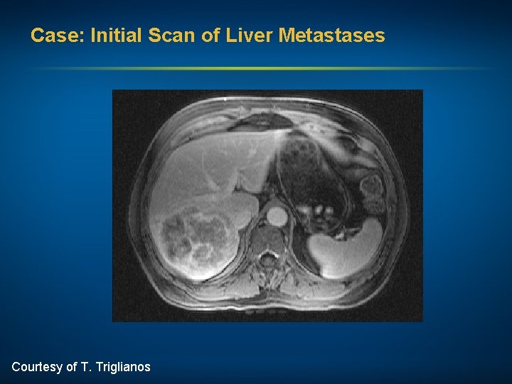 Case: Initial Scan of Liver Metastases Courtesy of T. Triglianos 