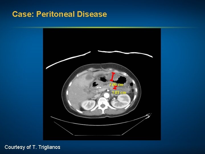 Case: Peritoneal Disease 2. 86 cm 1. 03 cm Courtesy of T. Triglianos 