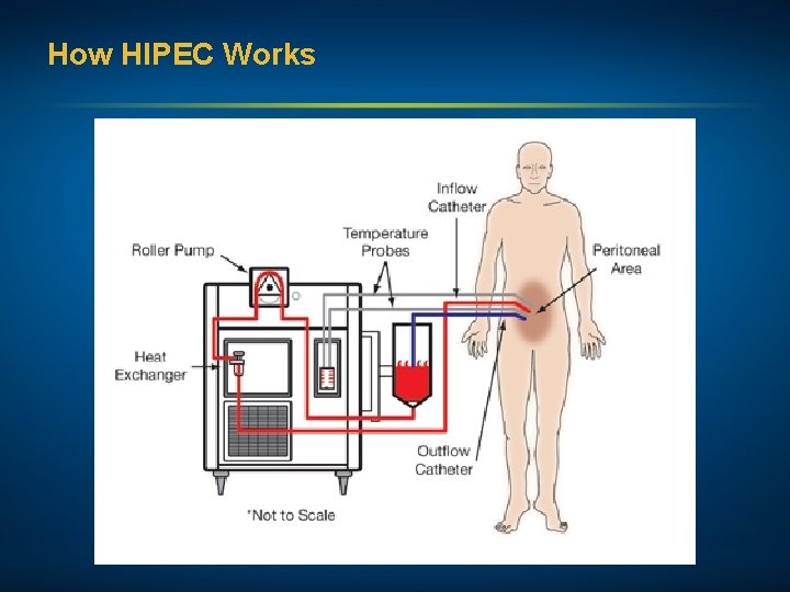 How HIPEC Works 
