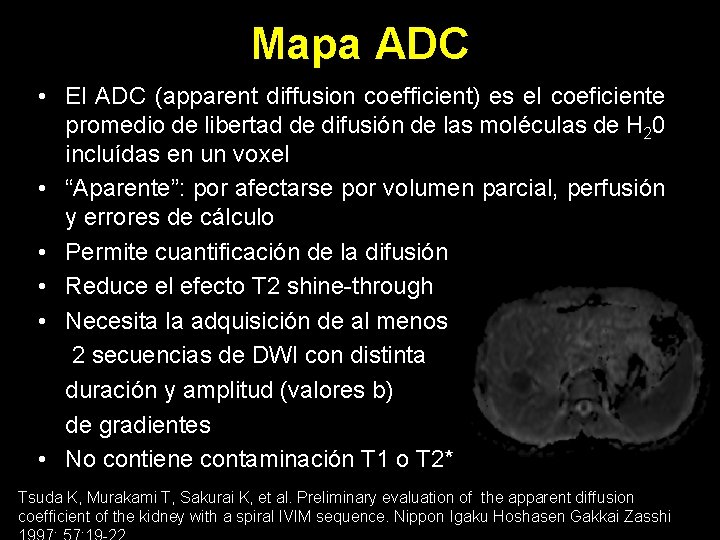 Mapa ADC • El ADC (apparent diffusion coefficient) es el coeficiente promedio de libertad