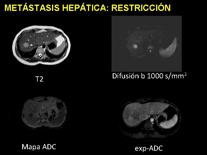 METÁSTASIS HEPÁTICA: RESTRICCIÓN T 2 Difusión b 1000 s/mm 2 Mapa ADC exp-ADC 