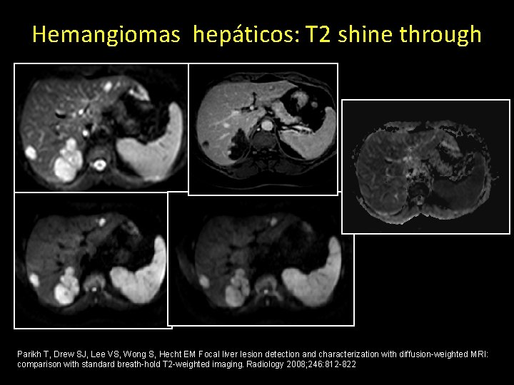 Hemangiomas hepáticos: T 2 shine through Parikh T, Drew SJ, Lee VS, Wong S,