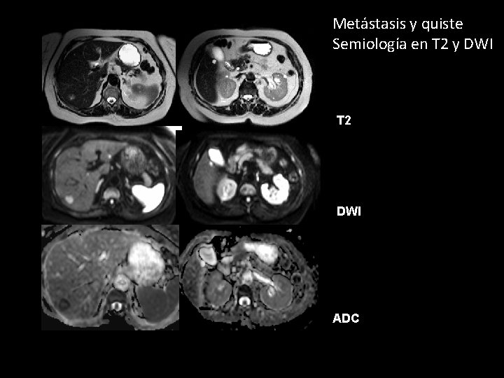 Metástasis y quiste Semiología en T 2 y DWI T 2 DWI ADC 