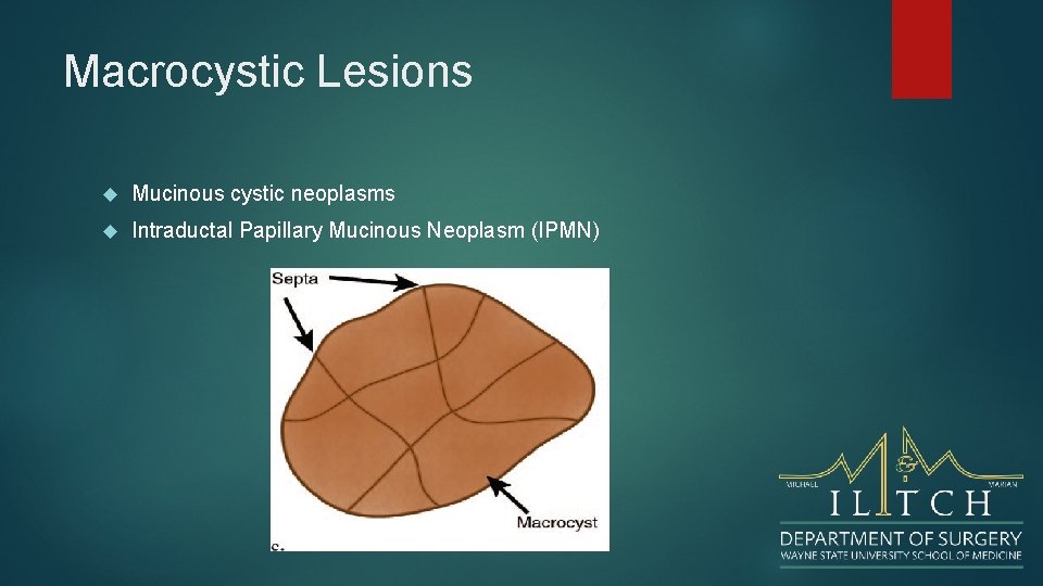 Macrocystic Lesions Mucinous cystic neoplasms Intraductal Papillary Mucinous Neoplasm (IPMN) 