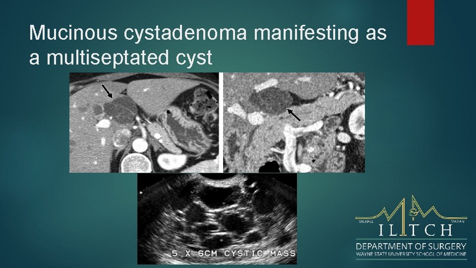 Mucinous cystadenoma manifesting as a multiseptated cyst 