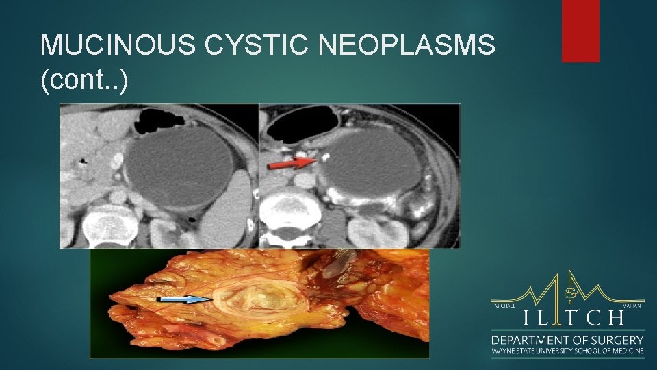MUCINOUS CYSTIC NEOPLASMS (cont. . ) 