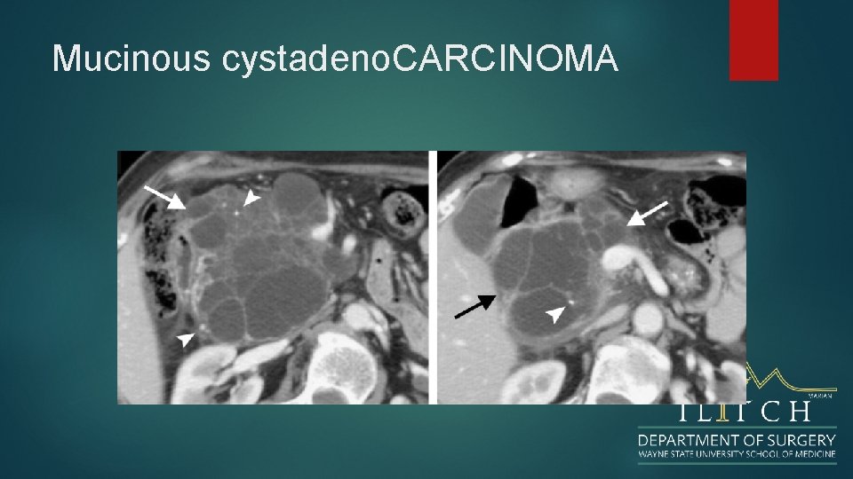 Mucinous cystadeno. CARCINOMA 