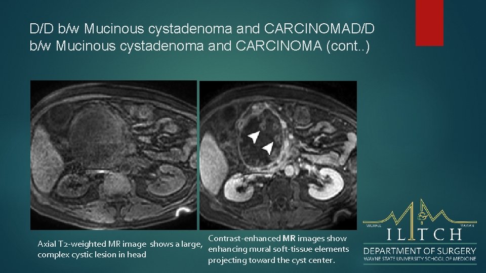 D/D b/w Mucinous cystadenoma and CARCINOMA (cont. . ) Contrast-enhanced MR images show Axial