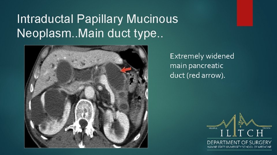 Intraductal Papillary Mucinous Neoplasm. . Main duct type. . Extremely widened main pancreatic duct