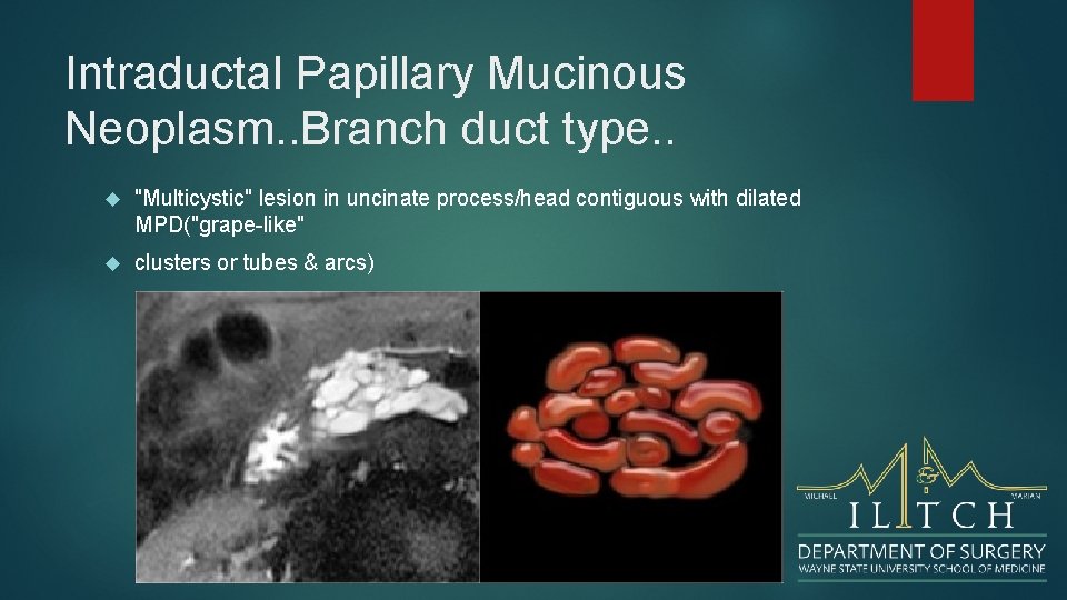 Intraductal Papillary Mucinous Neoplasm. . Branch duct type. . "Multicystic" lesion in uncinate process/head