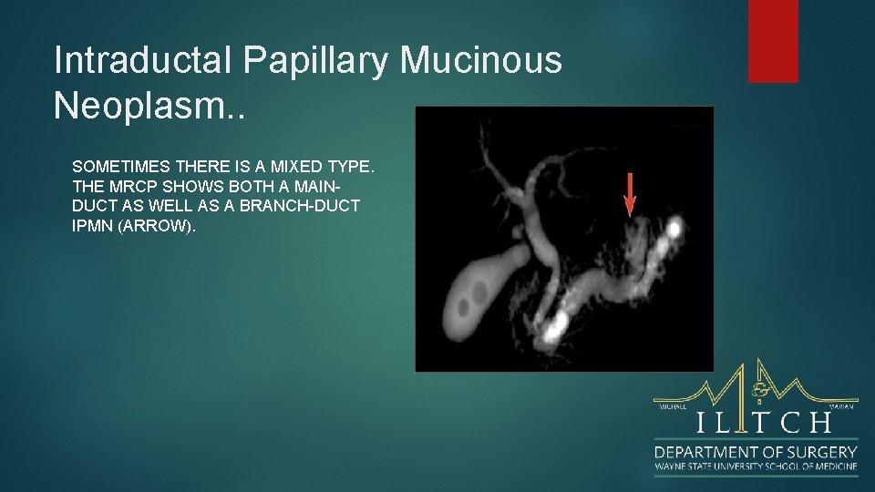 Intraductal Papillary Mucinous Neoplasm. . SOMETIMES THERE IS A MIXED TYPE. THE MRCP SHOWS