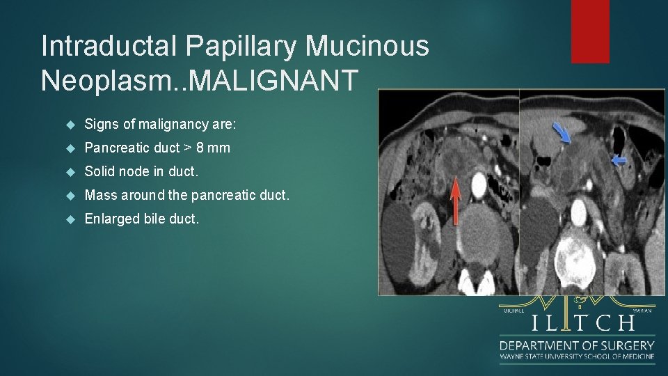 Intraductal Papillary Mucinous Neoplasm. . MALIGNANT Signs of malignancy are: Pancreatic duct > 8