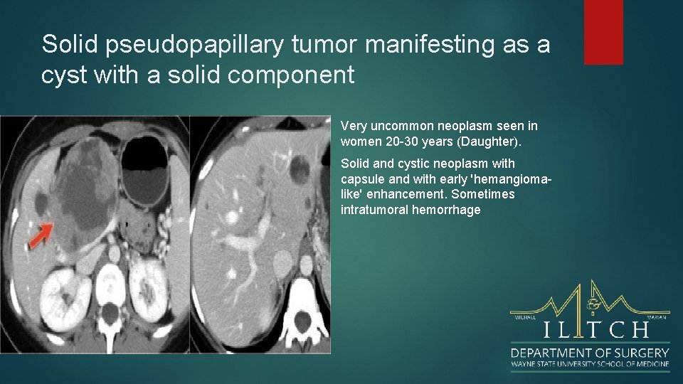 Solid pseudopapillary tumor manifesting as a cyst with a solid component Very uncommon neoplasm