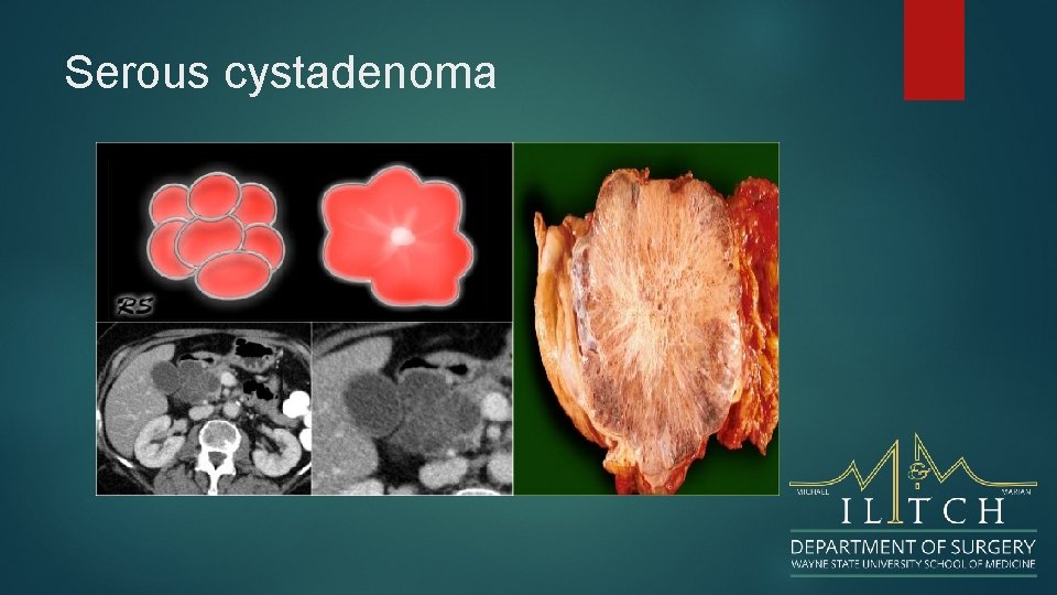 Serous cystadenoma 