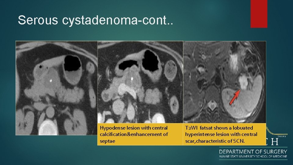 Serous cystadenoma-cont. . Hypodense lesion with central calcification&enhancement of septae T 2 WI fatsat