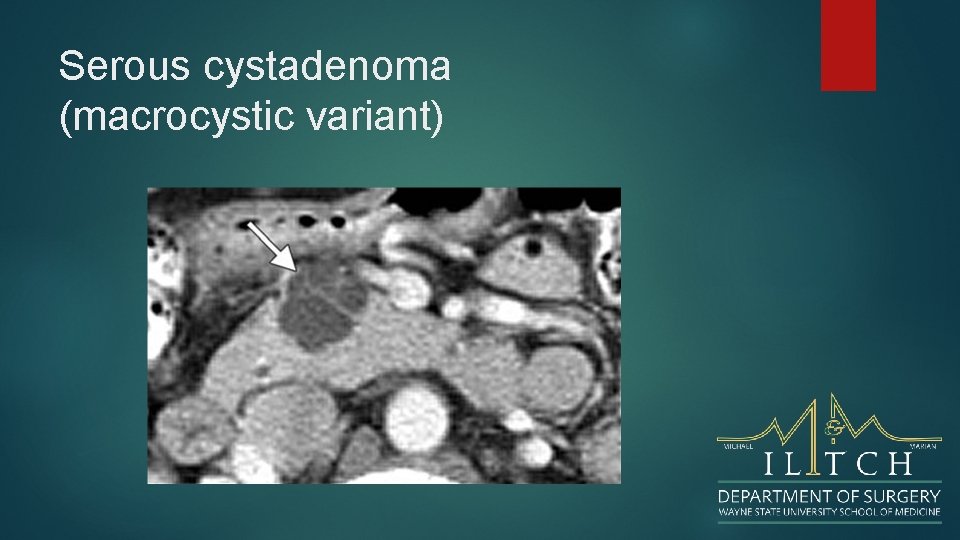 Serous cystadenoma (macrocystic variant) 