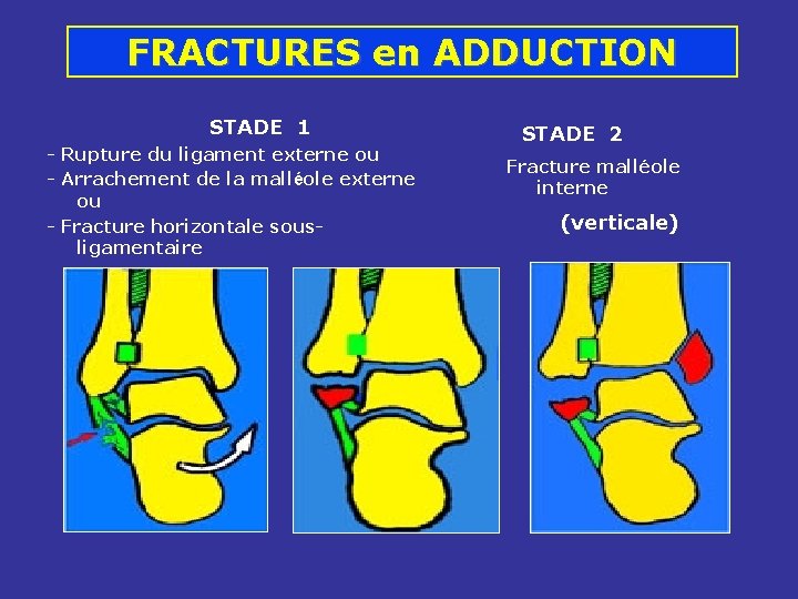 FRACTURES en ADDUCTION STADE 1 - Rupture du ligament externe ou - Arrachement de