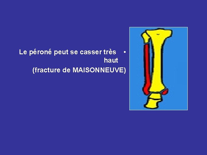 Le péroné peut se casser très • haut (fracture de MAISONNEUVE) 