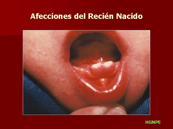 Afecciones del Recién Nacido HGNPE 