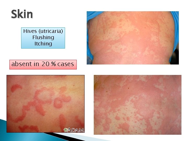 Skin Hives (utricaria) Flushing Itching absent in 20 % cases 