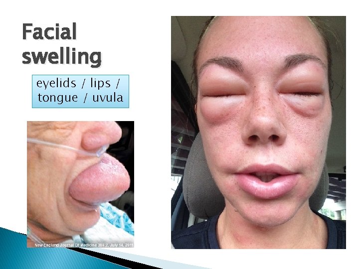 Facial swelling eyelids / lips / tongue / uvula 