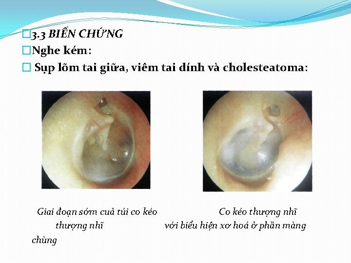 � 3. 3 BIẾN CHỨNG �Nghe kém: � Sụp lõm tai giữa, viêm tai