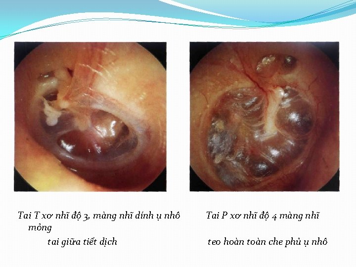 Tai T xơ nhĩ độ 3, màng nhĩ dính ụ nhô mỏng tai giữa