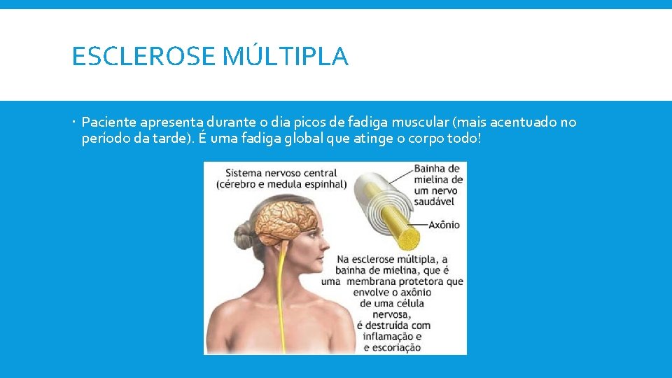 ESCLEROSE MÚLTIPLA Paciente apresenta durante o dia picos de fadiga muscular (mais acentuado no