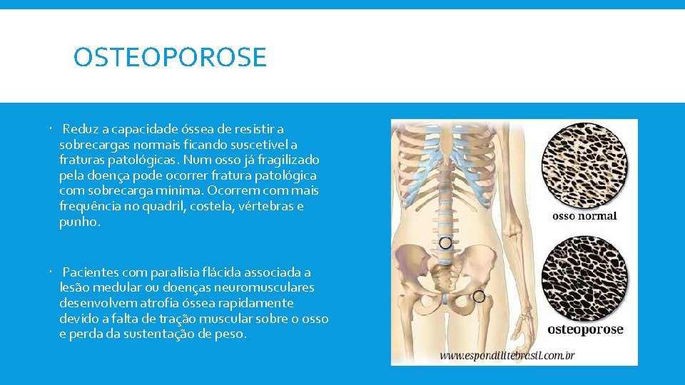 OSTEOPOROSE Reduz a capacidade óssea de resistir a sobrecargas normais ficando suscetível a fraturas