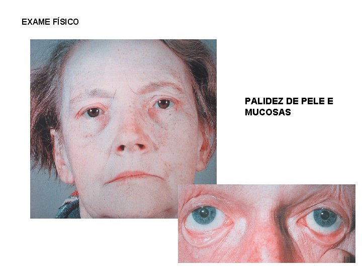 EXAME FÍSICO PALIDEZ DE PELE E MUCOSAS 