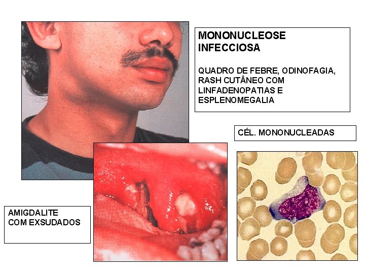 MONONUCLEOSE INFECCIOSA QUADRO DE FEBRE, ODINOFAGIA, RASH CUT NEO COM LINFADENOPATIAS E ESPLENOMEGALIA CÉL.