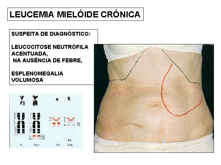 LEUCEMIA MIELÓIDE CRÓNICA SUSPEITA DE DIAGNÓSTICO: LEUCOCITOSE NEUTRÓFILA ACENTUADA, NA AUSÊNCIA DE FEBRE, ESPLENOMEGALIA