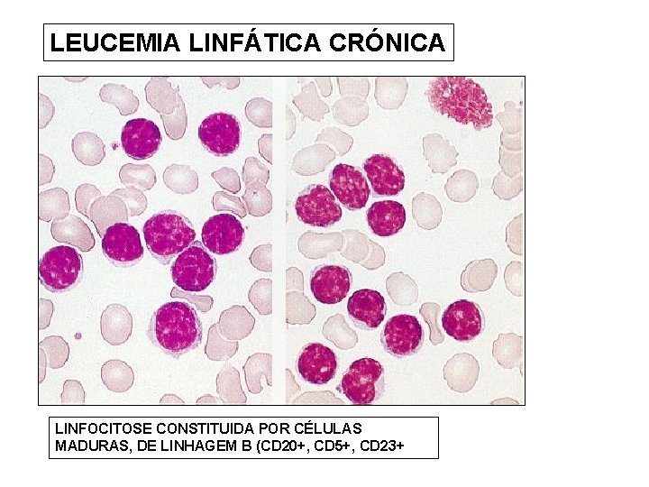 LEUCEMIA LINFÁTICA CRÓNICA LINFOCITOSE CONSTITUIDA POR CÉLULAS MADURAS, DE LINHAGEM B (CD 20+, CD