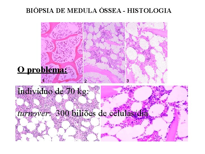 BIÓPSIA DE MEDULA ÓSSEA - HISTOLOGIA O problema: Indivíduo de 70 kg: turnover: 300