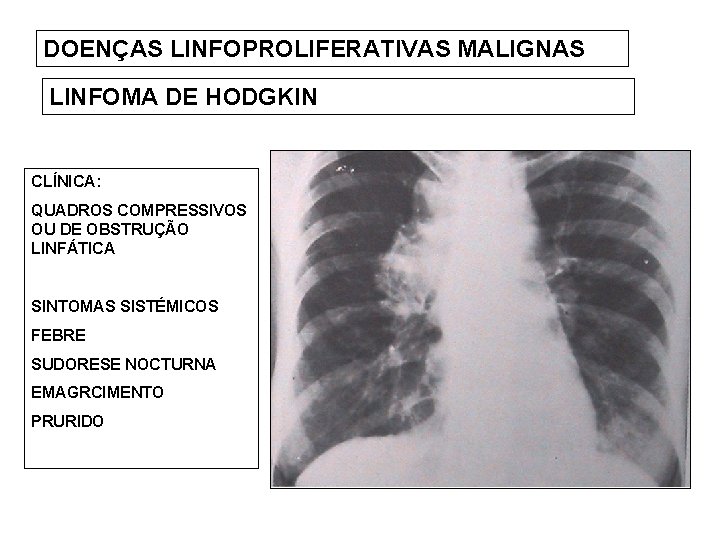 DOENÇAS LINFOPROLIFERATIVAS MALIGNAS LINFOMA DE HODGKIN CLÍNICA: QUADROS COMPRESSIVOS OU DE OBSTRUÇÃO LINFÁTICA SINTOMAS