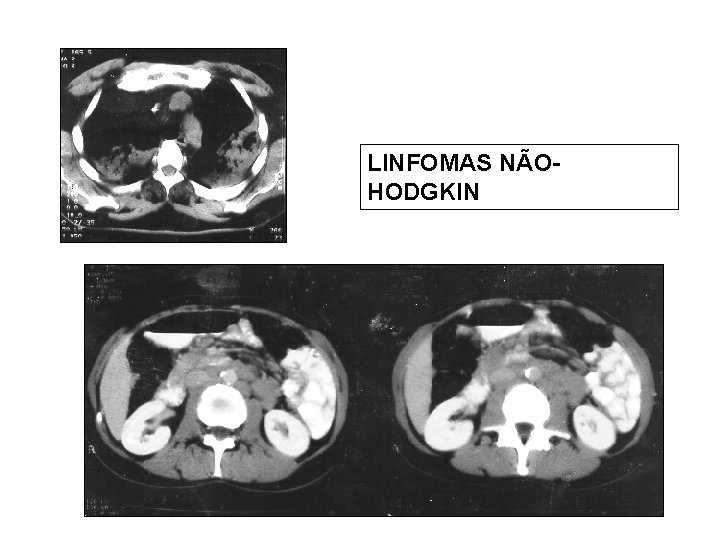 LINFOMAS NÃOHODGKIN 