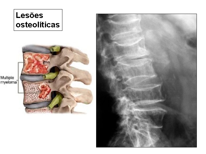 Lesões osteolíticas 