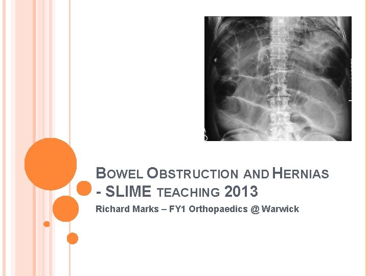 BOWEL OBSTRUCTION AND HERNIAS - SLIME TEACHING 2013 Richard Marks – FY 1 Orthopaedics